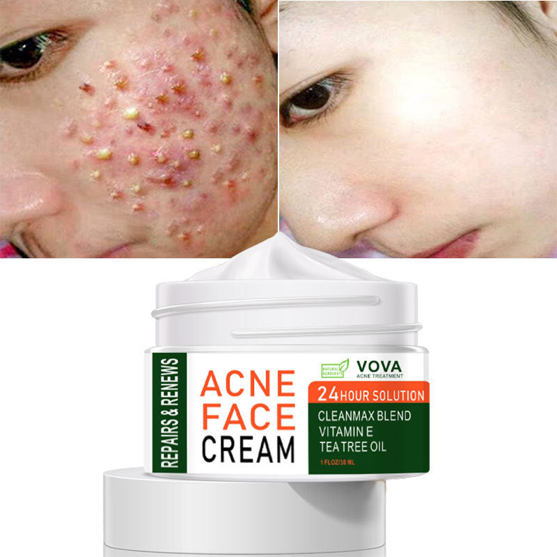 跨境现货VOVA ACNE FACE CREAM 30ml 速卖通亚马逊可授权